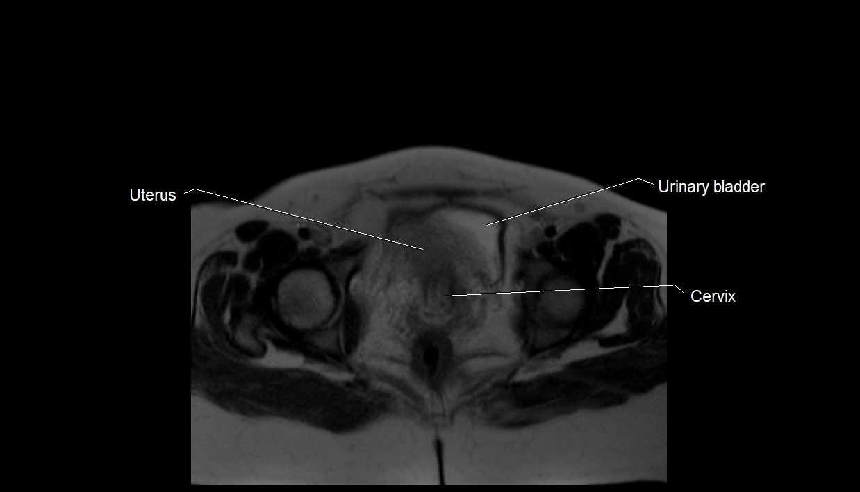MRI fetal anatomy axial image 38.webp